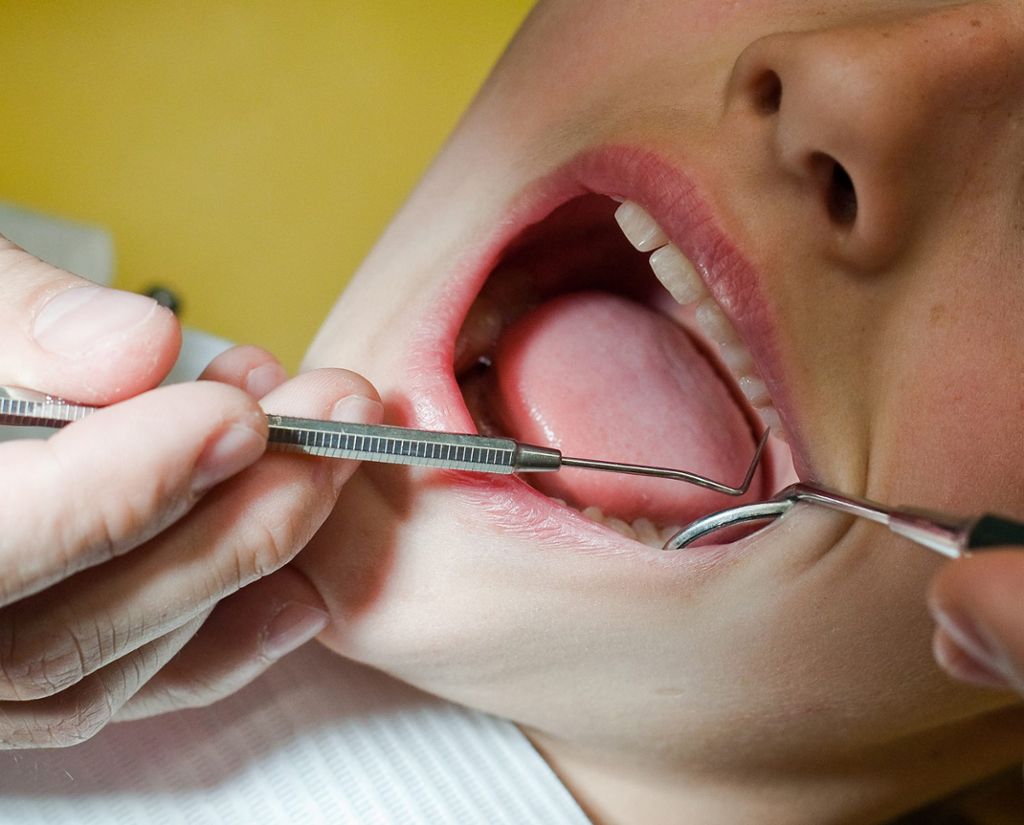 Grundlos Zähne gezogen: Anklage gegen Zahnarzt